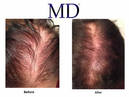 MD Nutri Hair Cabello Saludable