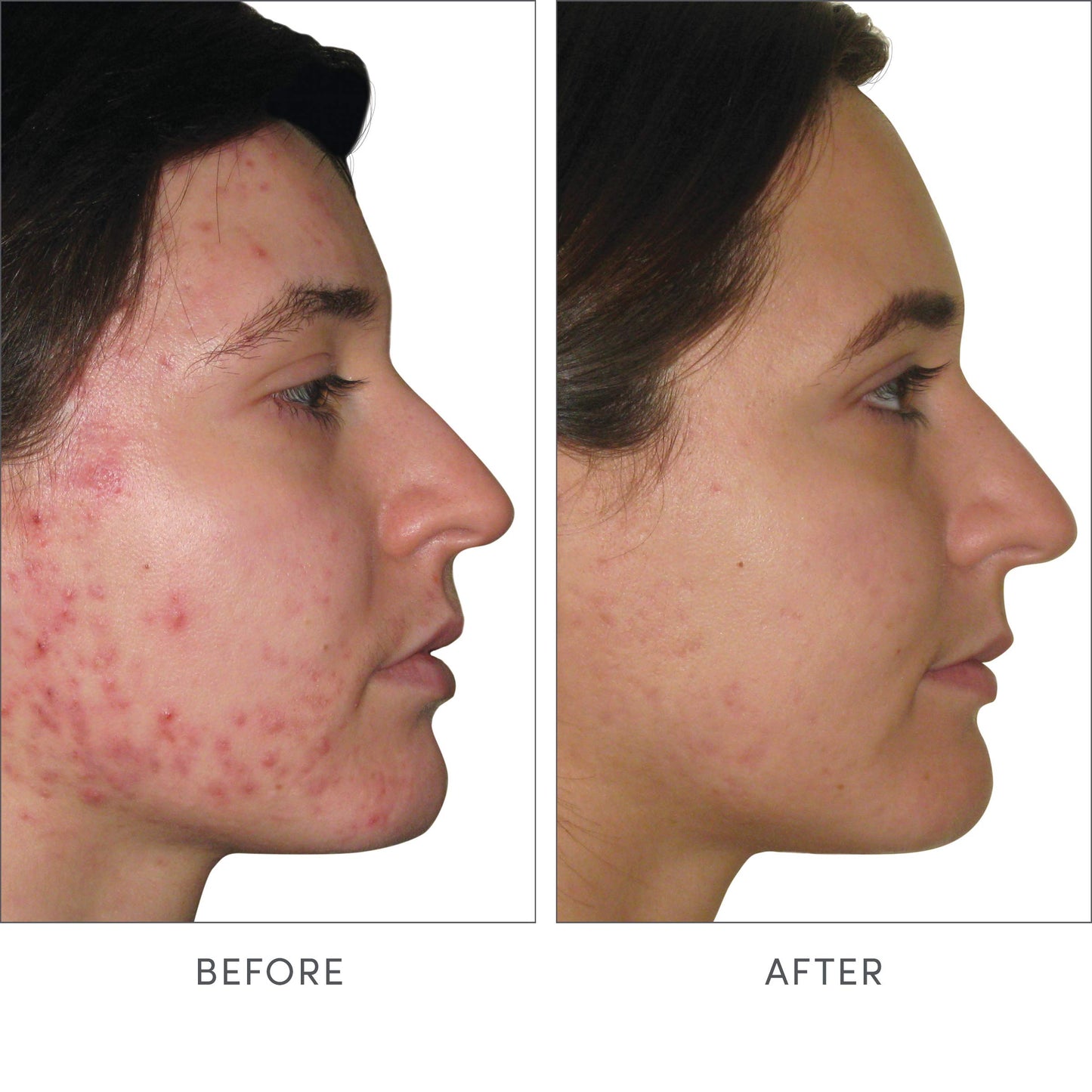 Suplemento Skin Accumax cápsulas para piel sin acné