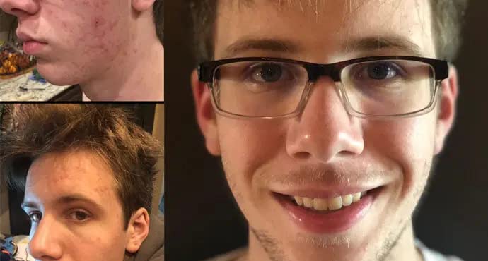 Efecto beneficioso de vitaminas para acné en piel masculina