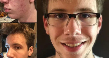 Efecto beneficioso de vitaminas para acné en piel masculina