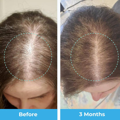 Gomitas Baby Blues para mamás con caída de cabello