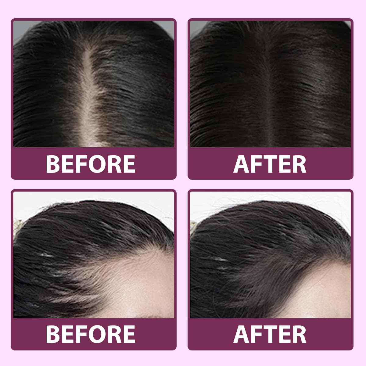 Gomitas masticables Honneth para cabello saludable