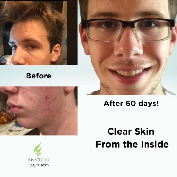 Cápsulas Clear Skin para tratamiento de acné con antioxidantes