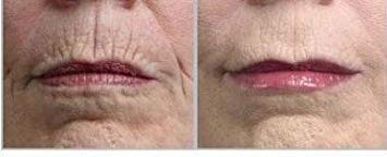 Aplicacion de crema en la piel