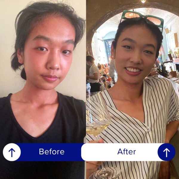 Parche aplicado en la piel