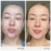 Version 1.0.0 Skin Accumax apoyo para piel propensa a imperfecciones