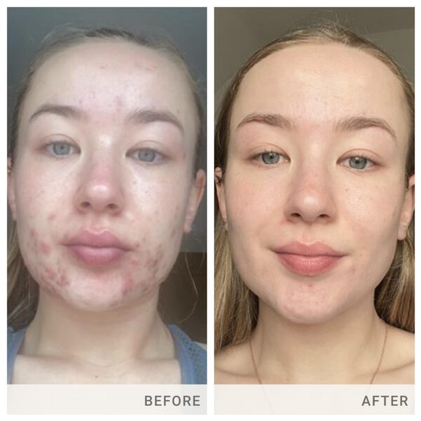 Version 1.0.0 Skin Accumax apoyo para piel propensa a imperfecciones