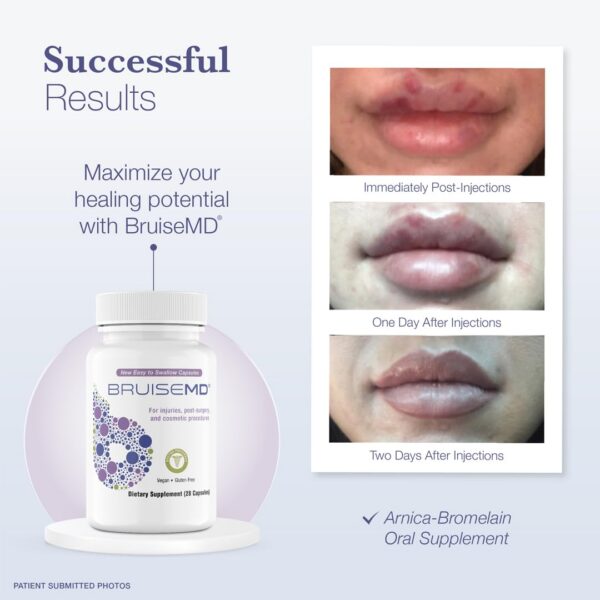 Version 1.0.0 Informacion de uso en etiqueta BruiseMD