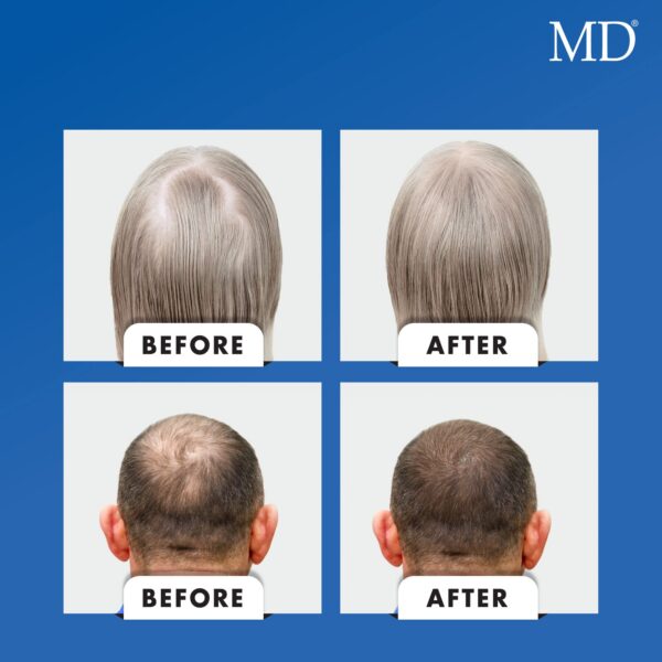 Cápsulas MD Nutri con biotina y vitaminas para cabello