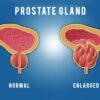 Etiqueta Pulean fórmula natural para próstata agrandada